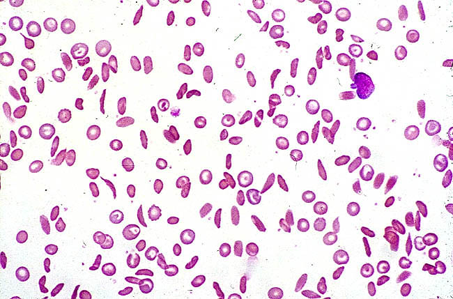Sickle cell anemia case study nursing